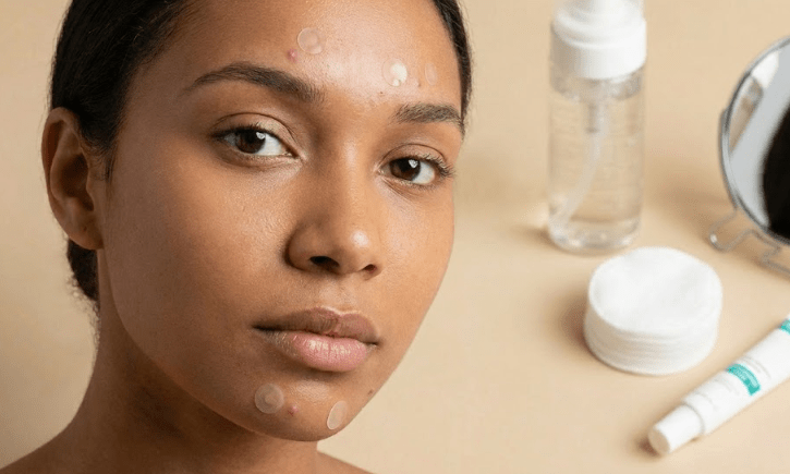 Do Acne Patches Really Work? What to Expect - Beauty Exchange Beauty Supply