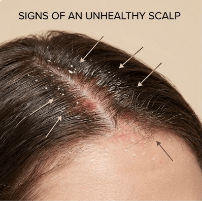 Signs Your Scalp Needs Treatment - Beauty Exchange Beauty Supply