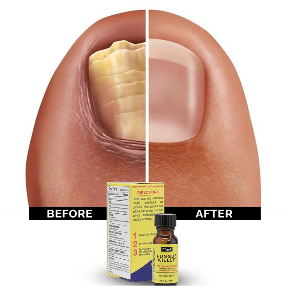 Pro Nail Fungus Killer Antifungal Treatment - 0.5oz - Beauty Exchange Beauty Supply