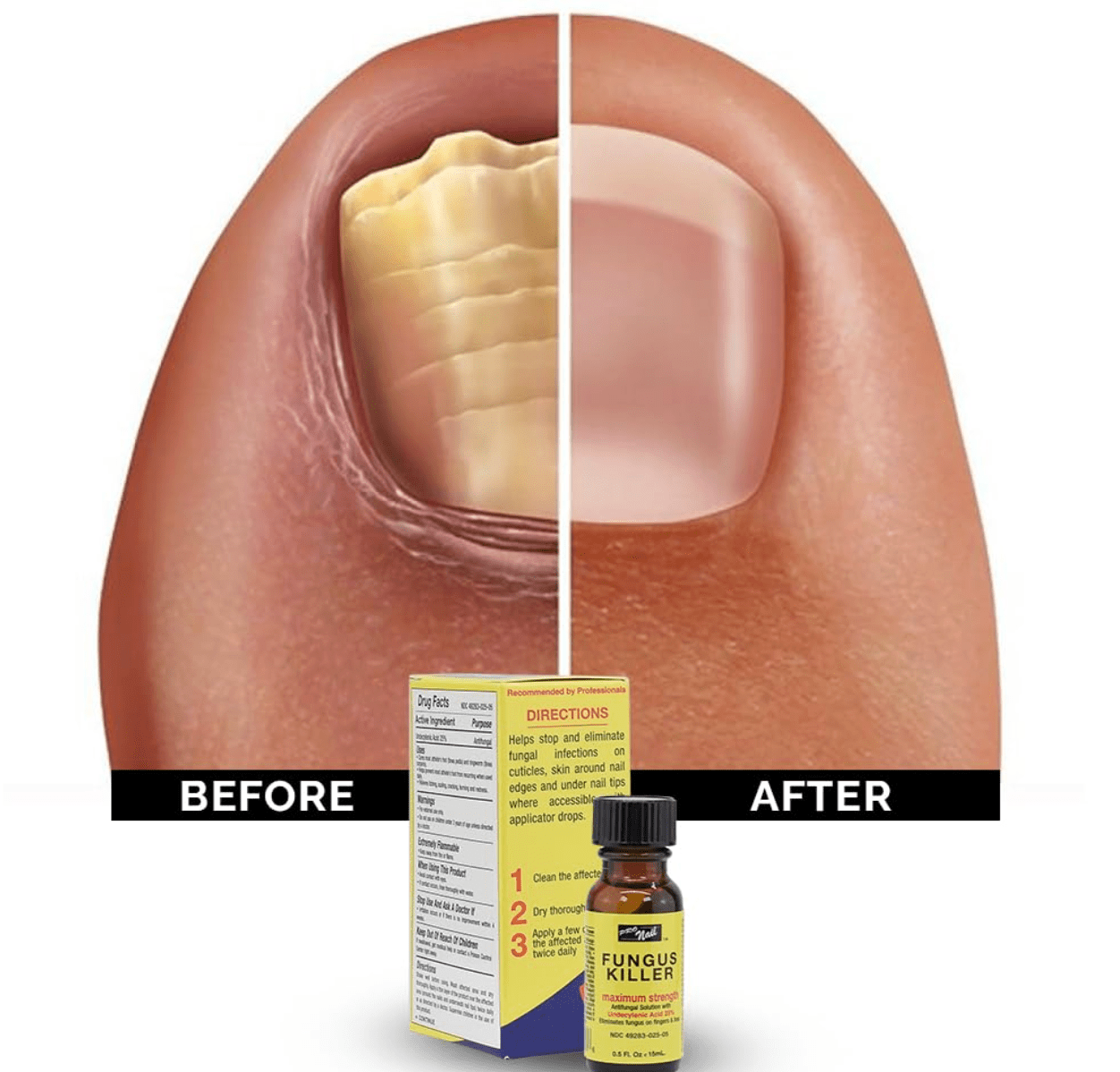 Pro Nail Fungus Killer Antifungal Treatment - 0.5oz - Beauty Exchange Beauty Supply